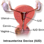 Myths and facts about. Intra-Uterine Devices